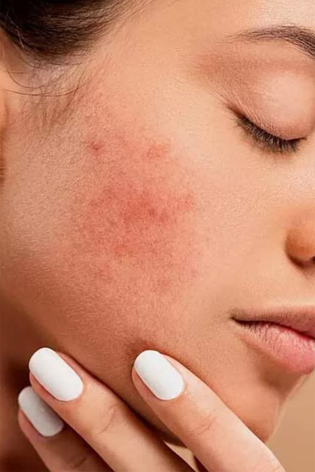 Clean & Glow - Skincare | cg behandeling acne behandeling 01